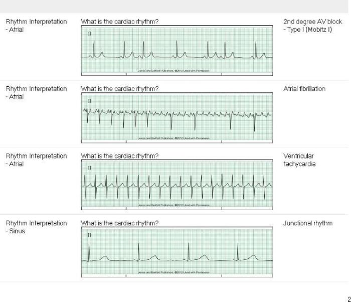 Relias dysrhythmia basic a 35 questions