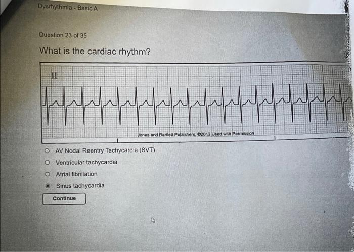 Relias dysrhythmia basic a 35 questions